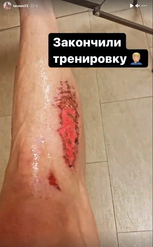 Тарасов показал повреждение ноги, которое получил на тренировке «Велеса»